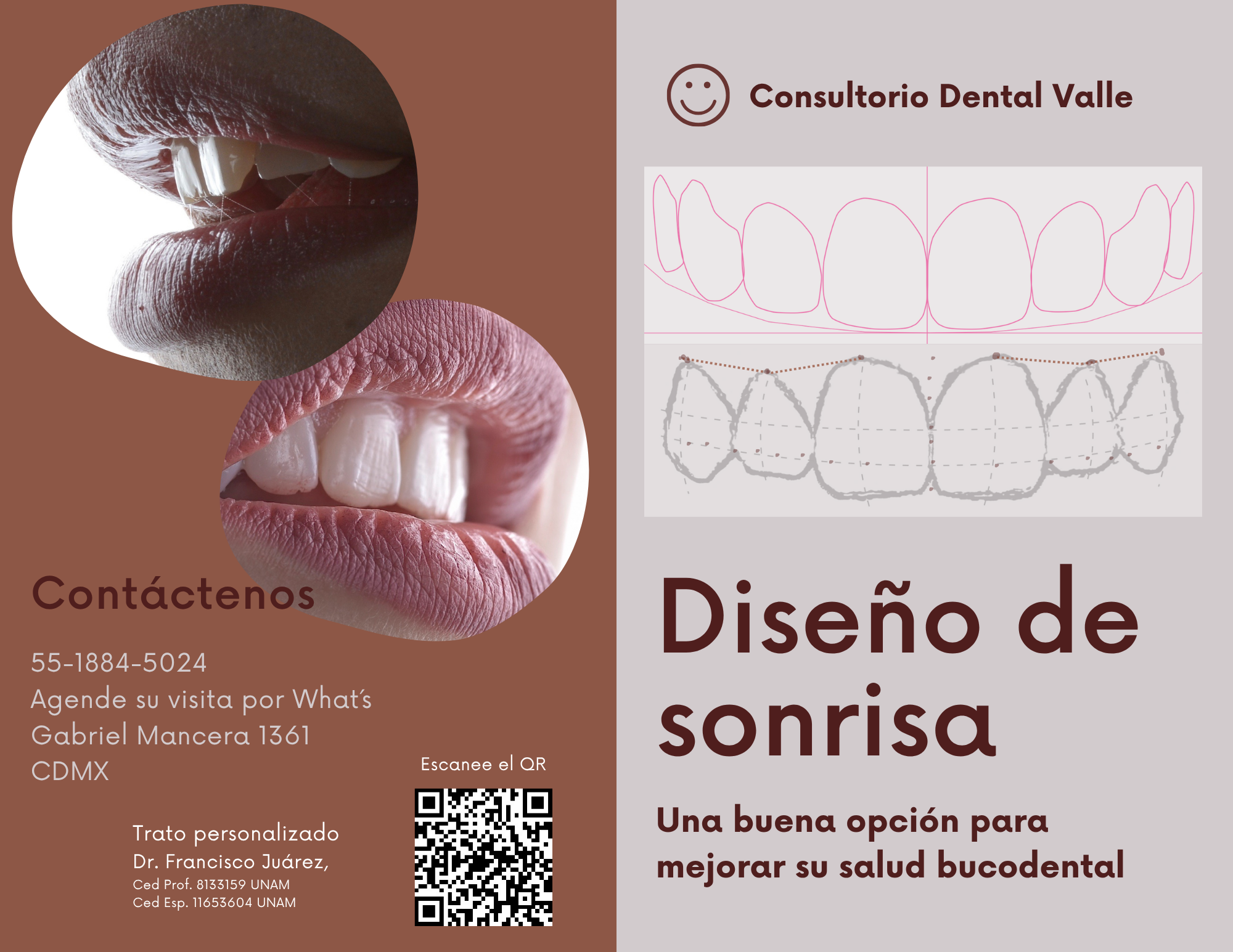 Diseño de Sonrisa y Carillas